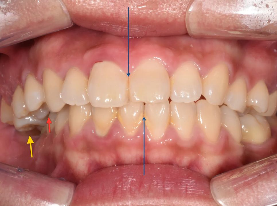 Before: over-erupted upper right molar, no contact on the right, midline off