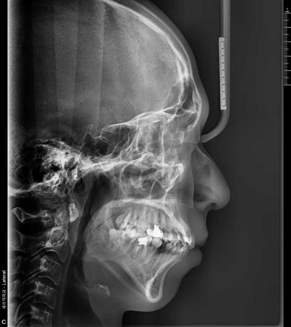 Side X-ray analysis: protrusion and a small lower jaw