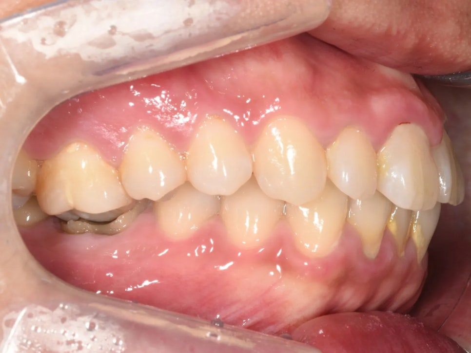 Before: the upper right molar that drifted down after decay