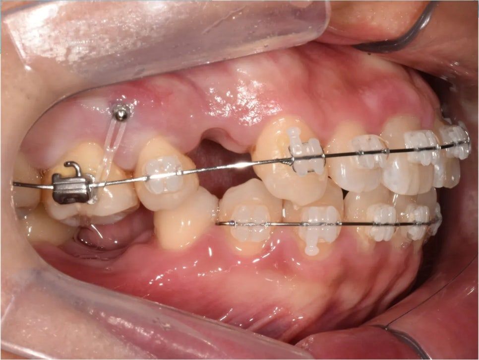 During treatment: force from a mini-screw pushing the molar back into the bone