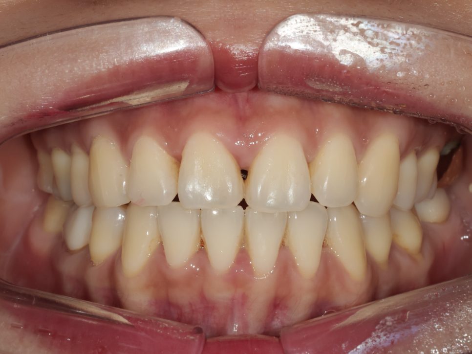 Before: the retainer wire showing through the black triangle between the upper front teeth