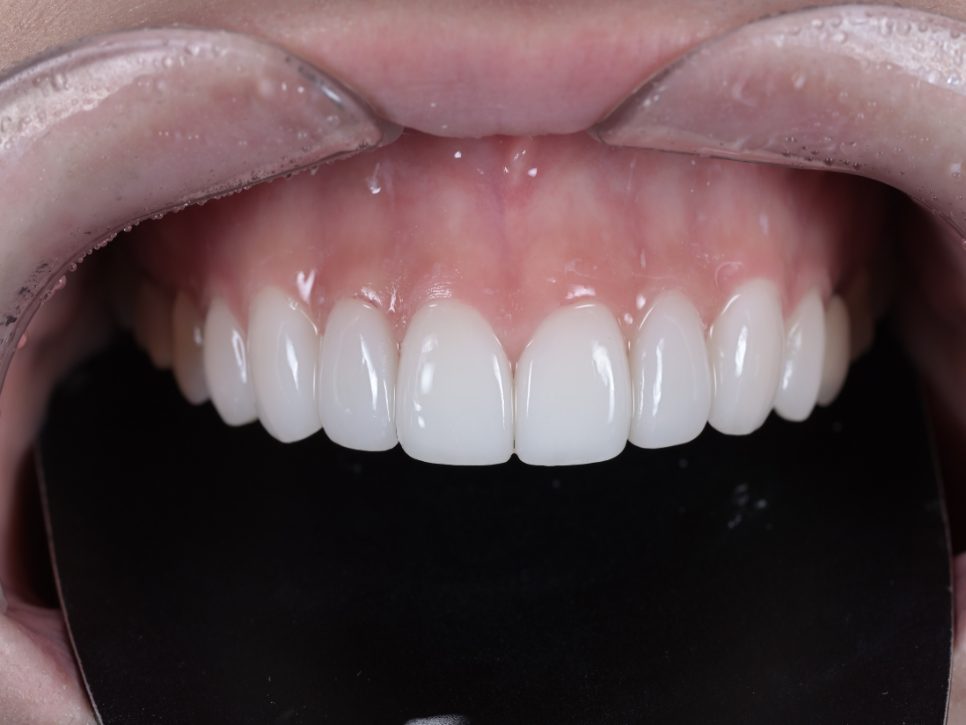 After: eight upper porcelain veneers closing the black triangle and changing tooth shape and shade (unretouched photo)
