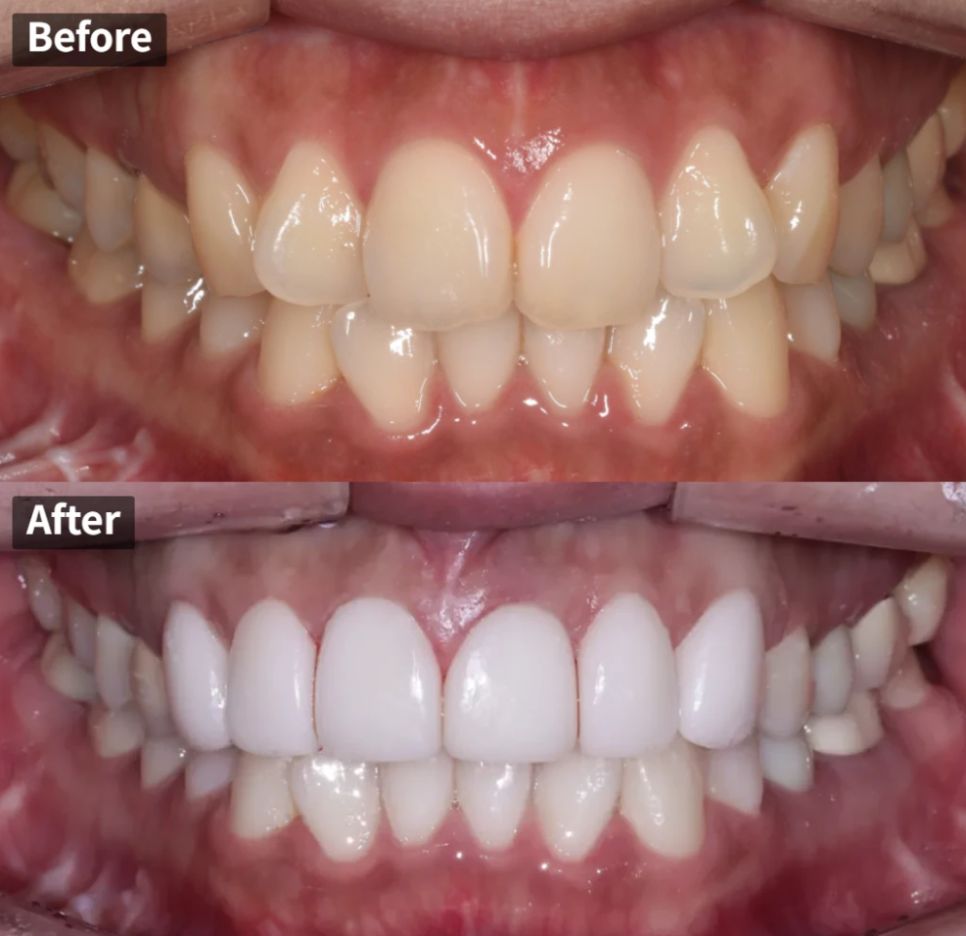 Crooked front teeth before and after six porcelain veneers