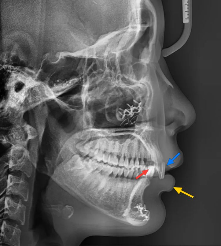 Before: side X-ray showing the upper incisors pressing on the lower lip
