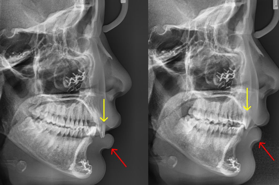 Side X-rays before and after: lips back in a natural position as the incisors moved