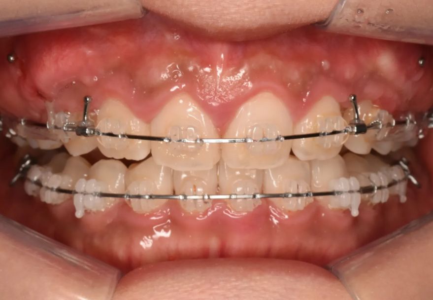 During treatment: the deep bite opening, lower incisors becoming visible