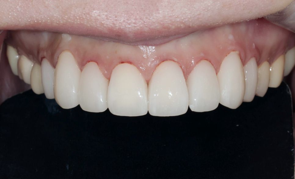 After: eight all-ceramic crowns on the upper front teeth