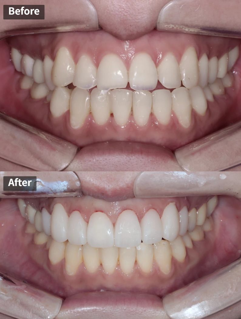 Front teeth with acid erosion, before and after eight all-ceramic crowns