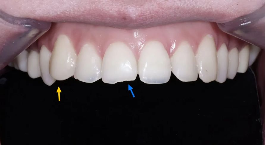 Before: thin, chipped edges of the upper front teeth