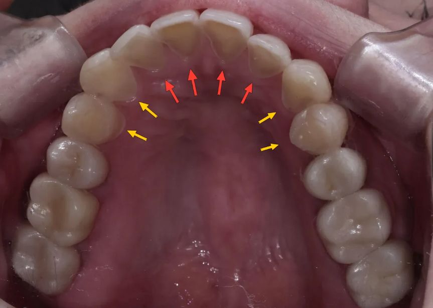 Before: back of the upper front teeth, heavily eroded by acid