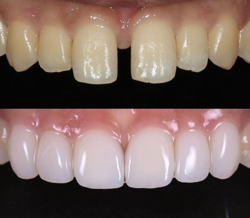 Gap between front teeth before (top) and after veneers (bottom)
