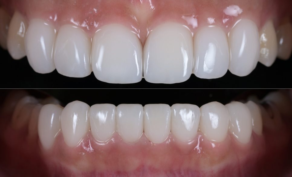 After: upper and lower front teeth with matched shade