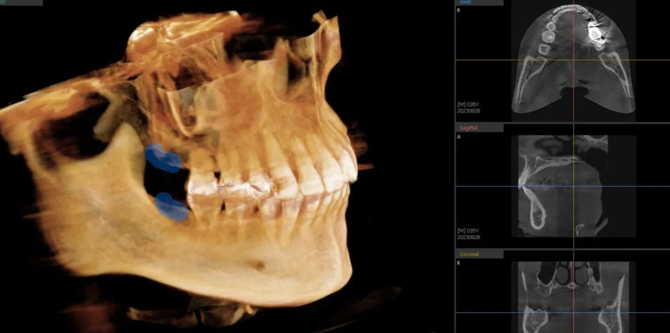 CT:後ろの骨のスペースが十分にあることを立体的に確認