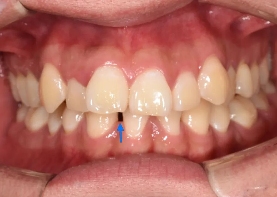 Before: the space from the missing lower teeth visible from the front