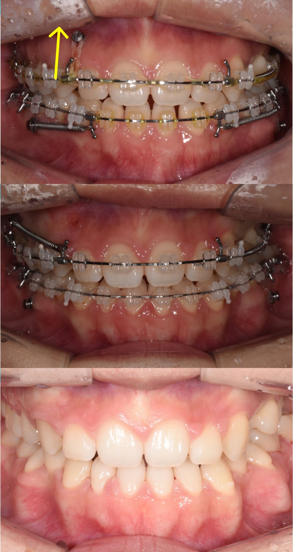 Progress from treatment to completion as the front teeth close