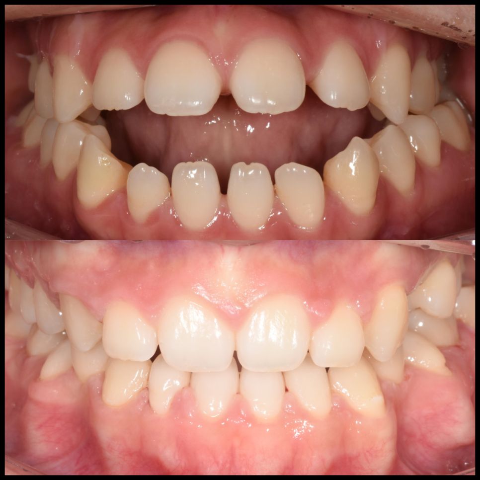 Open bite before and after treatment