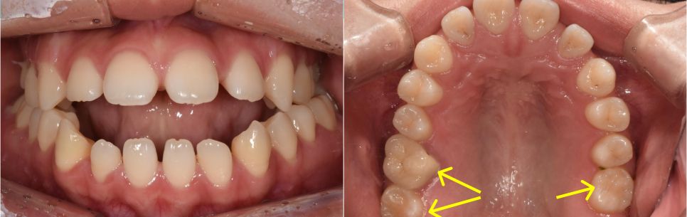 Before: front teeth not meeting even when the molars bite