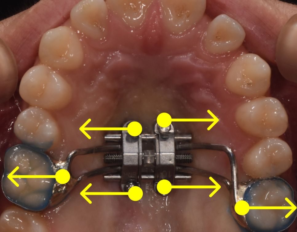 During treatment: MARPE upper jaw expander