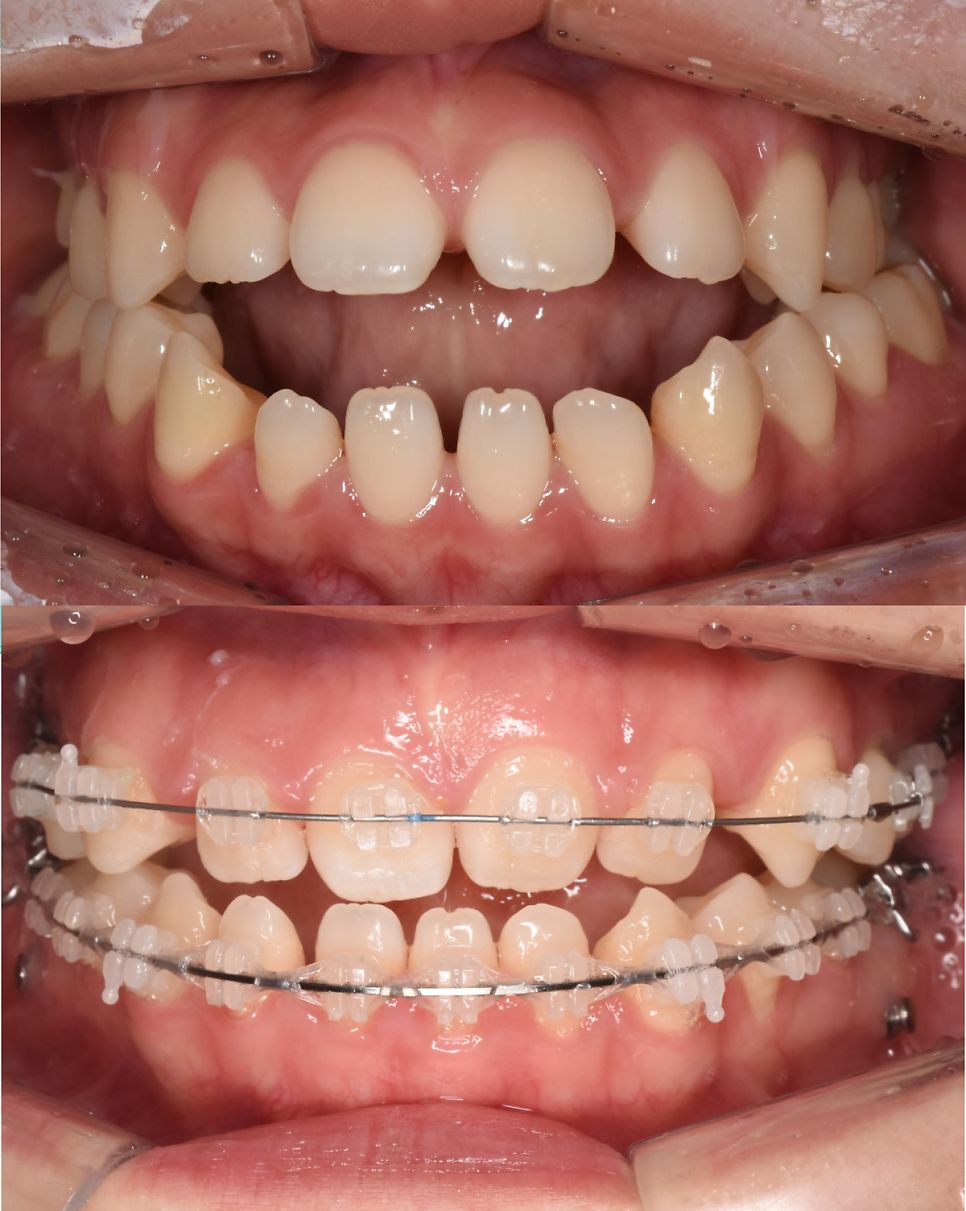 During treatment: braces aligning the teeth and bite