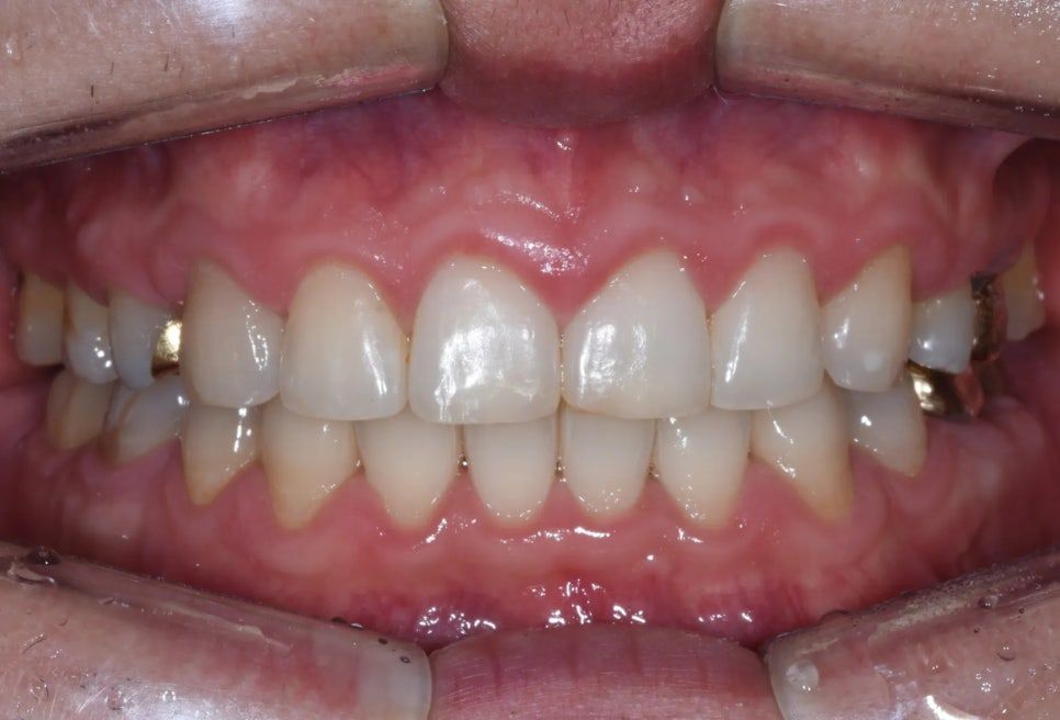 After: aligned teeth and reduced protrusion