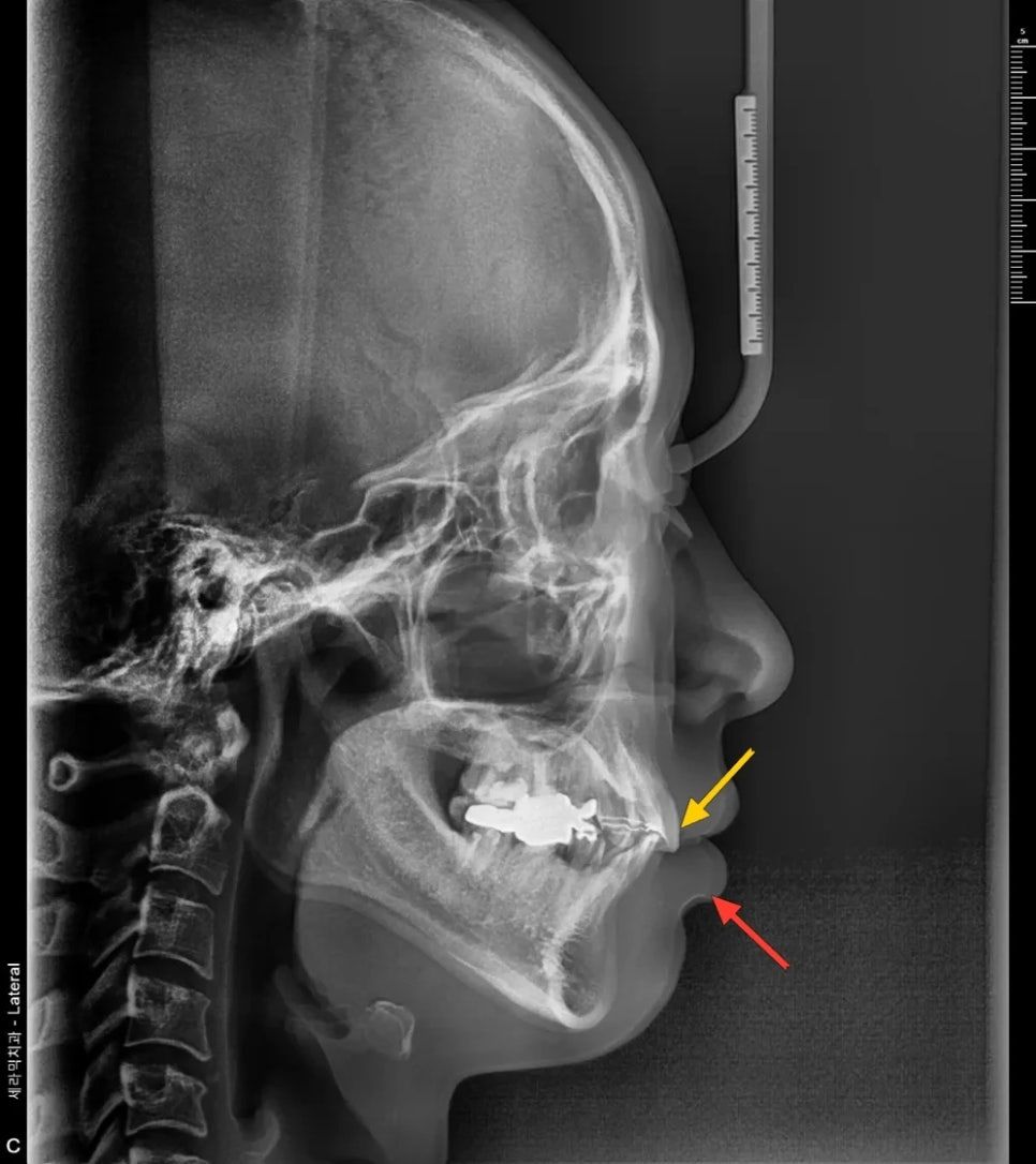 Before: side X-ray with the upper incisors pushing the lower lip