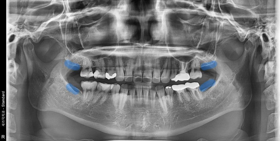 Panoramic X-ray: space behind the arch after wisdom tooth removal