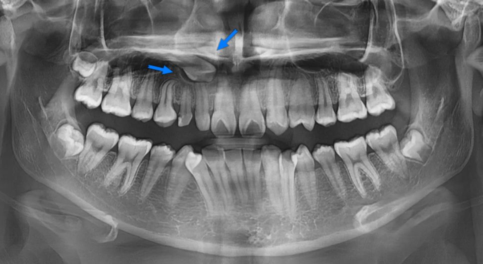 初診時のレントゲン：骨の中に埋まった犬歯