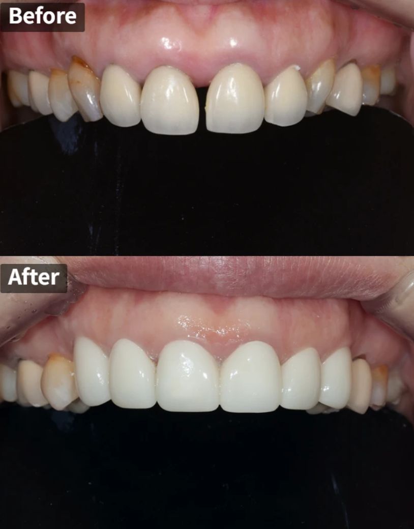 Old front tooth crowns replaced, before and after