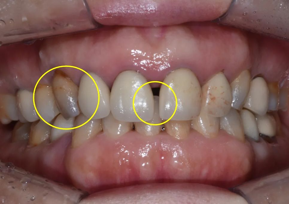 Before: gaps between the front teeth and a discolored canine