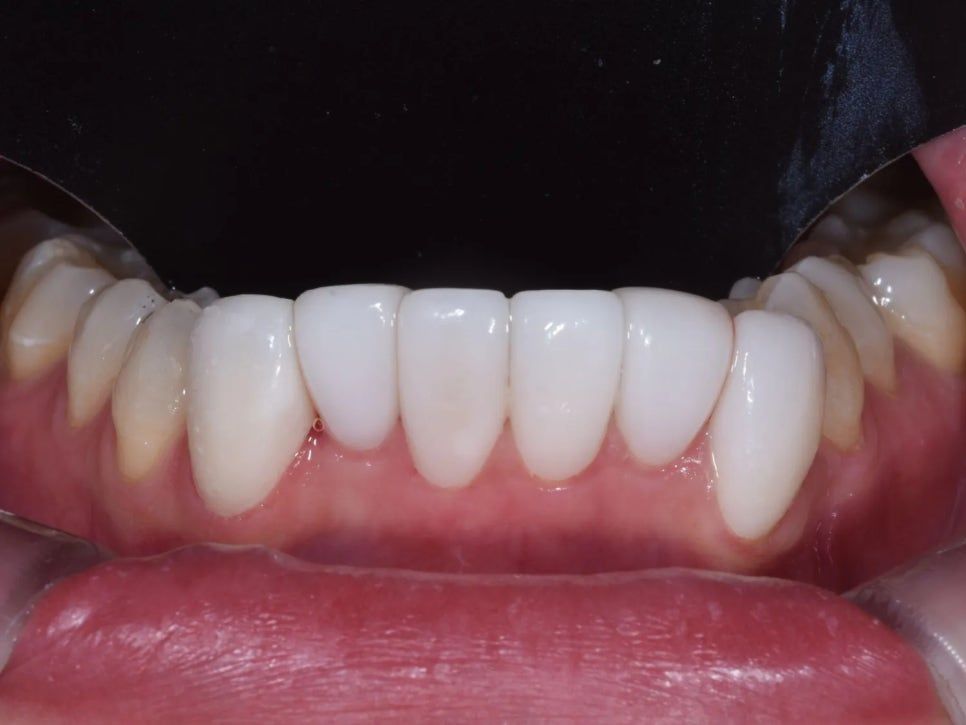 After: lower front teeth in harmony with the upper teeth