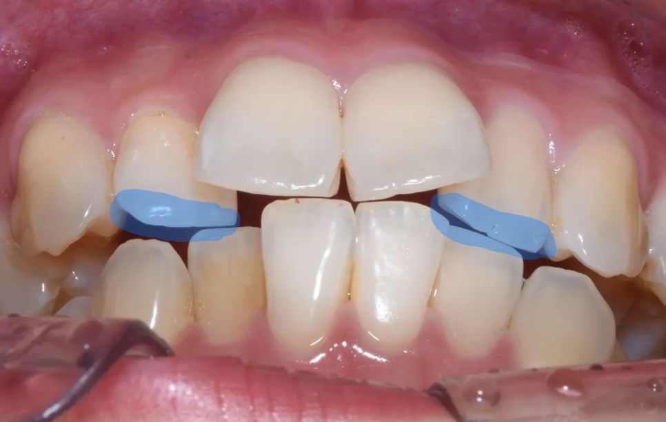 Before: without reduction, upper and lower restorations would collide