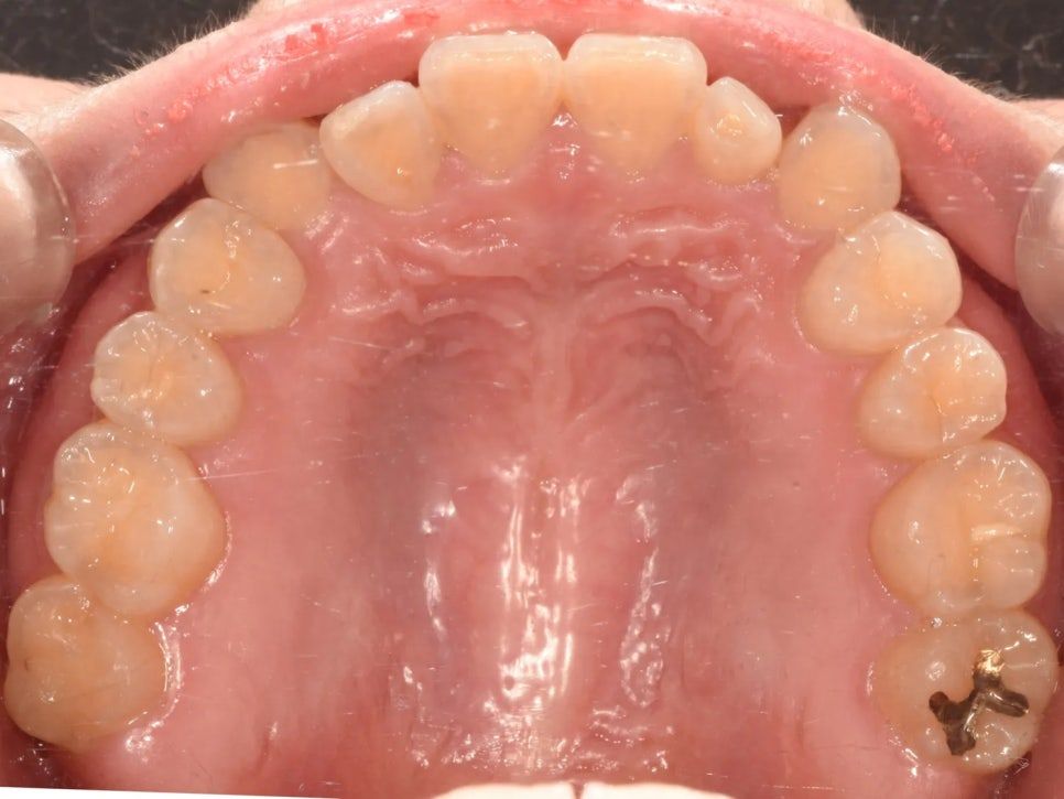 Before: upper arch with blocked-in lateral incisors and a small upper jaw
