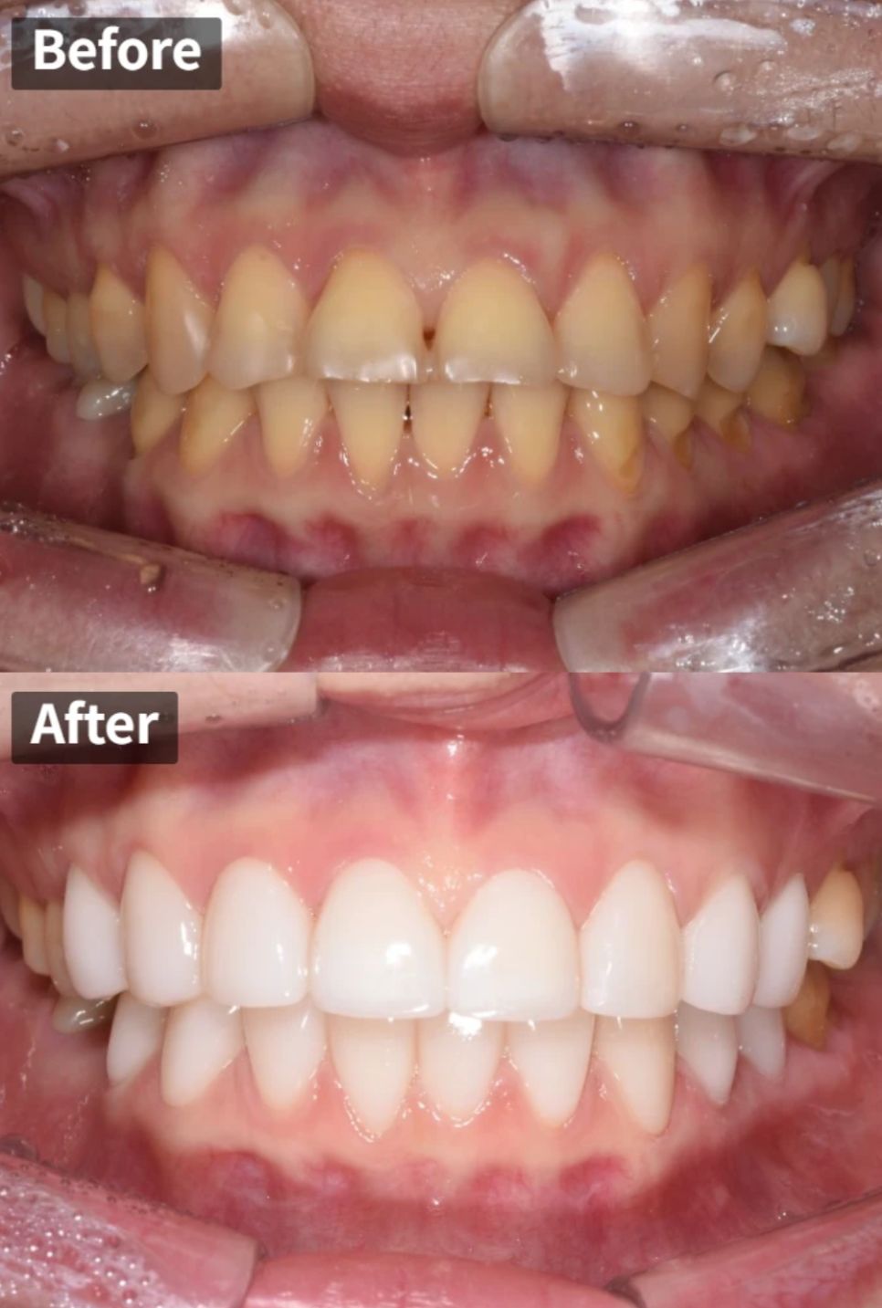 Yellow, uneven teeth before and after porcelain veneers