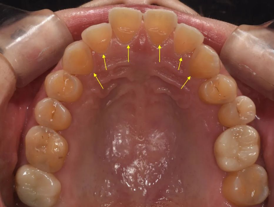 Before: worn back surfaces of the upper front teeth