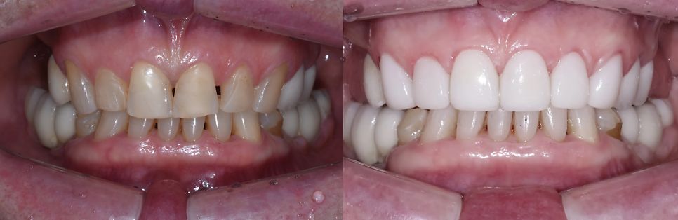 Black triangles and gaps between front teeth, before and after six veneers