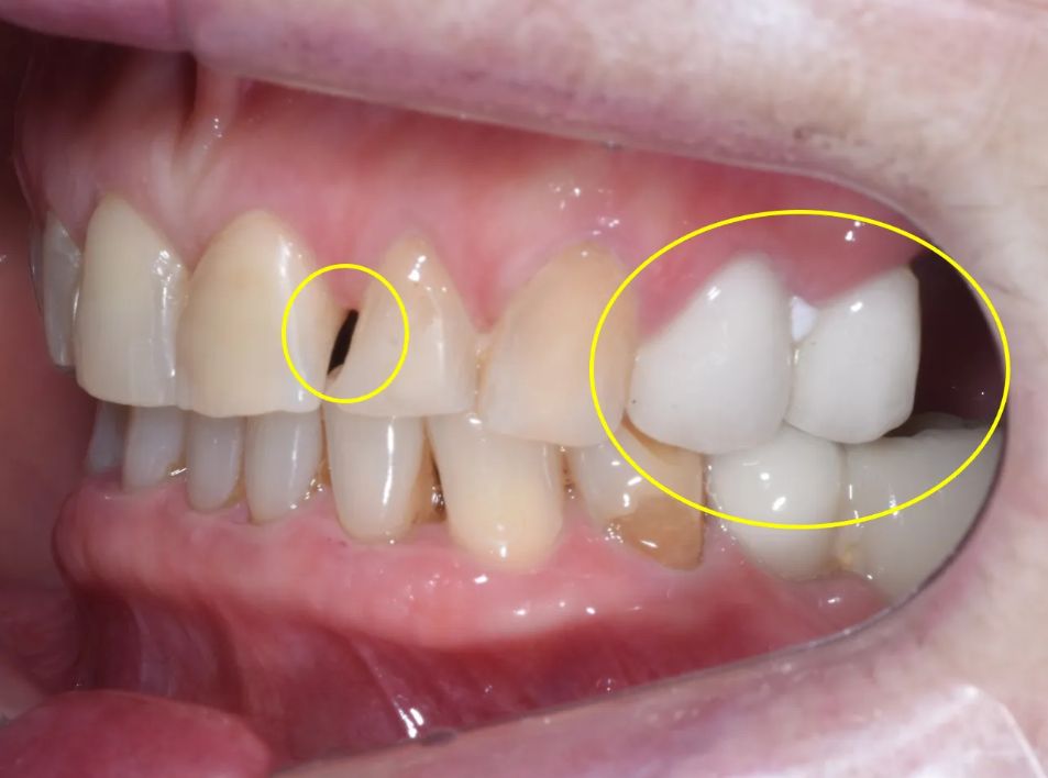 Before: gap next to the left front tooth and an existing crown