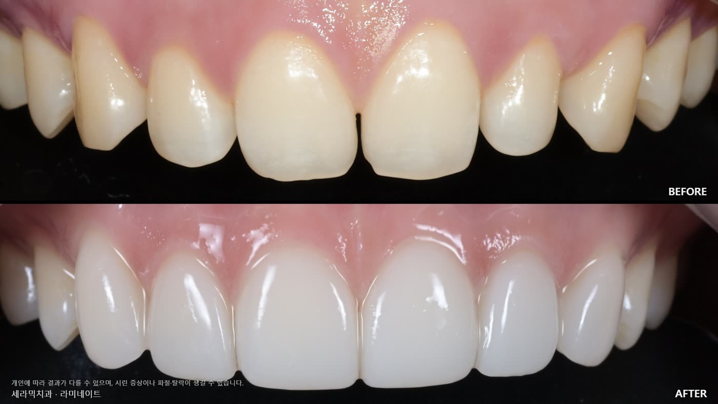 Veneer case: correcting yellowing and uneven lengths