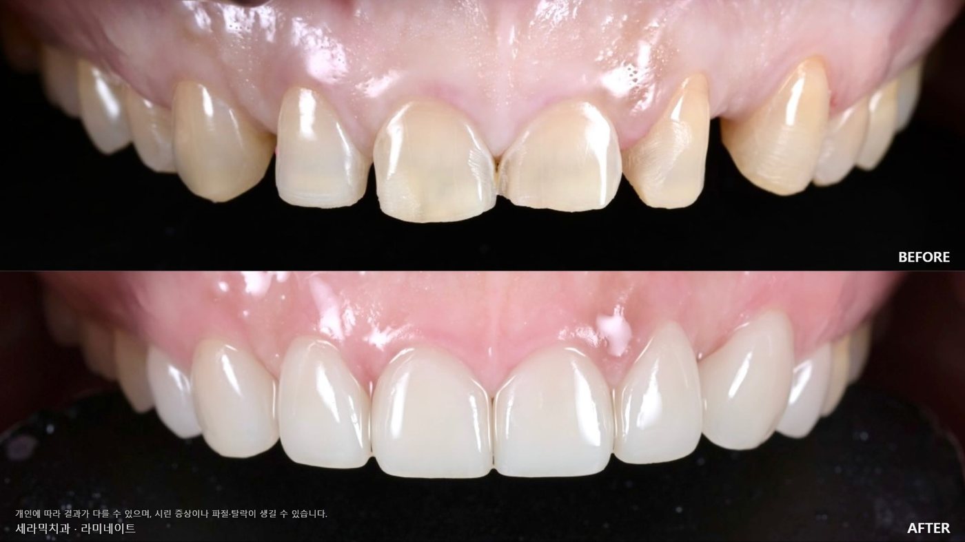 Worn, chipped front teeth evened out in length and shape