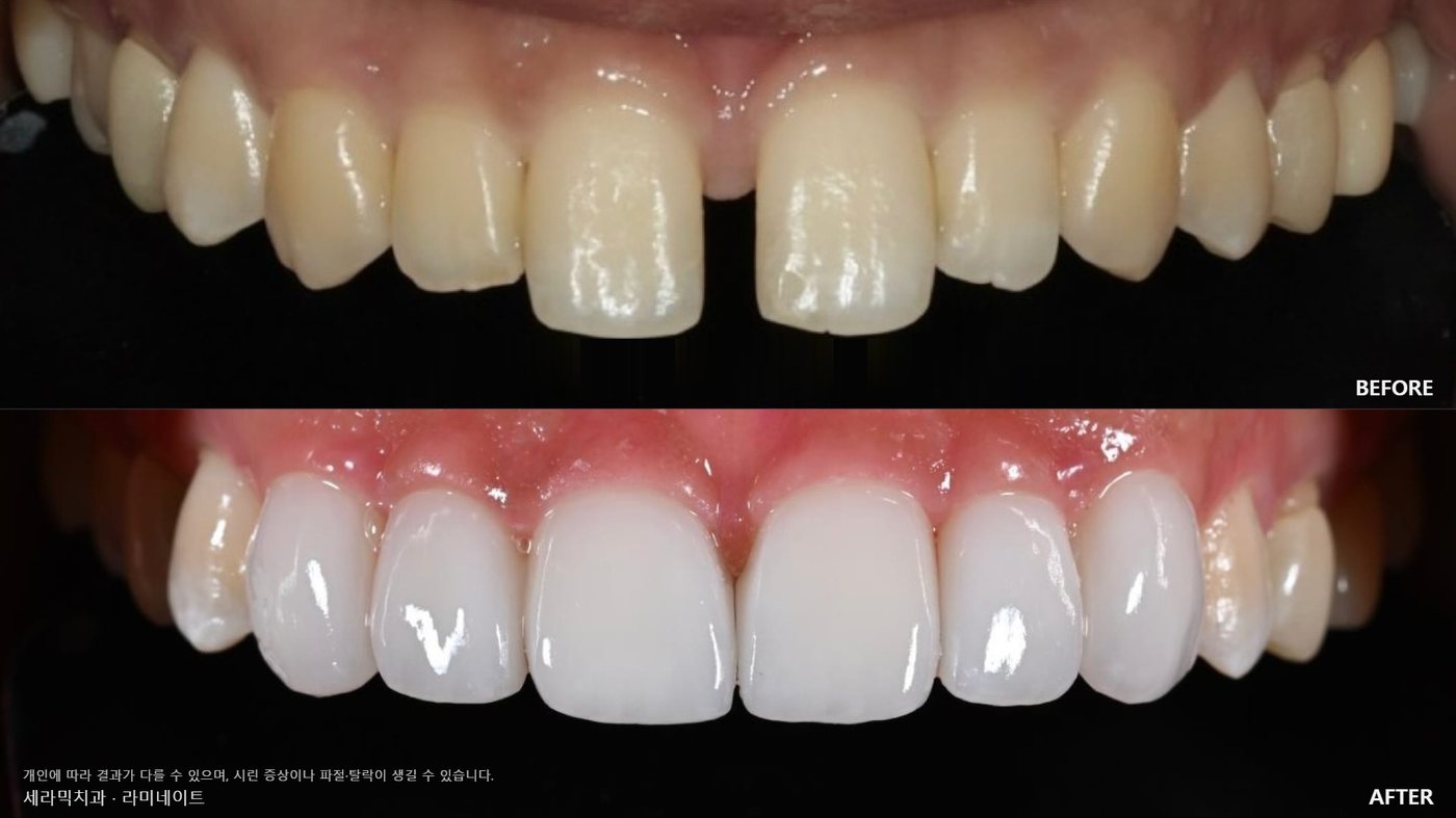 A gap between the front teeth closed with veneers