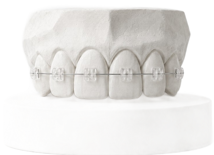 Tooth model with brackets attached (staged image)